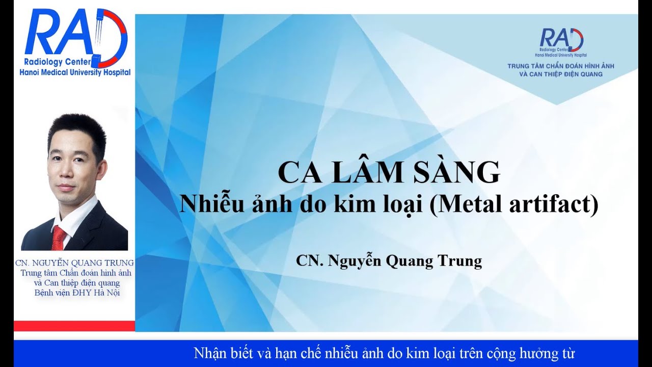 Nhận biết và hạn chế nhiễu ảnh do kim loại trên cộng hưởng từ