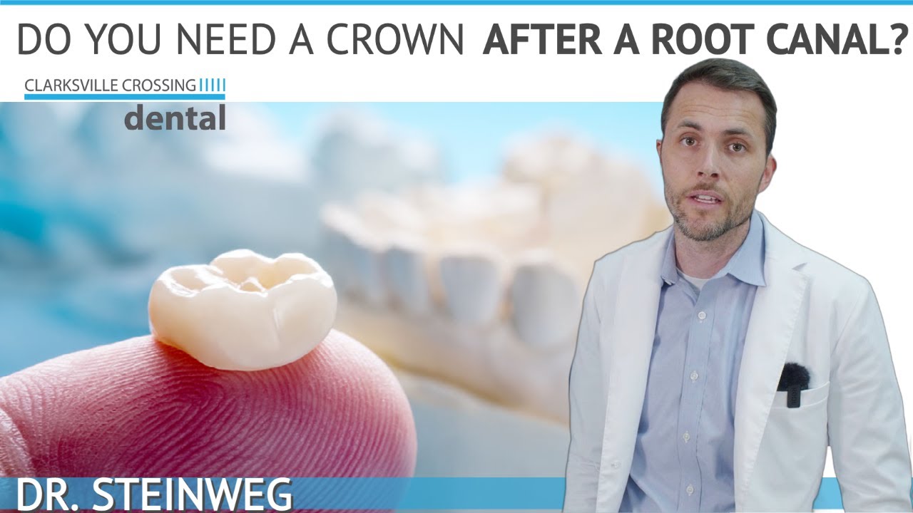 Do I Need Dental Crown After A Root Canal? 🤔