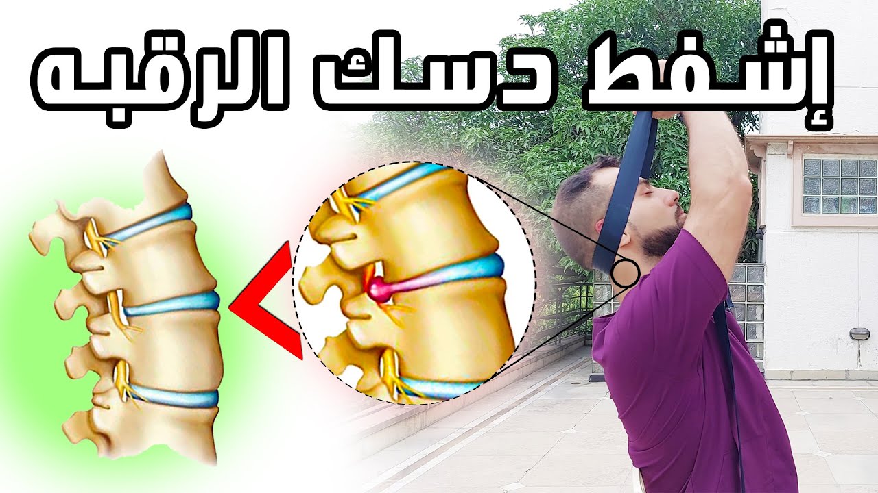 علاج ألم الرقبه || تنميل كهرباء من الكتف الى الاصابع || علاج انزلاق دسك غضروف الرقبه
