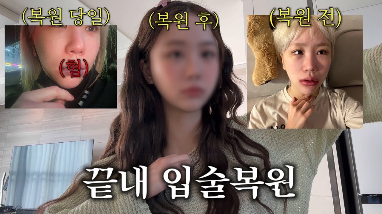 결국 입술 복원한 조두팔