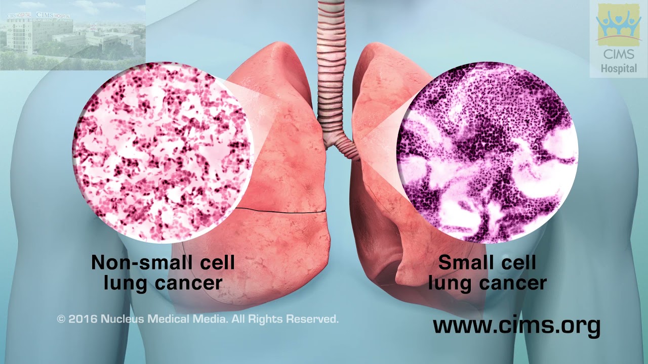 Understanding Lung Cancer (Hindi)– CIMS Hospital