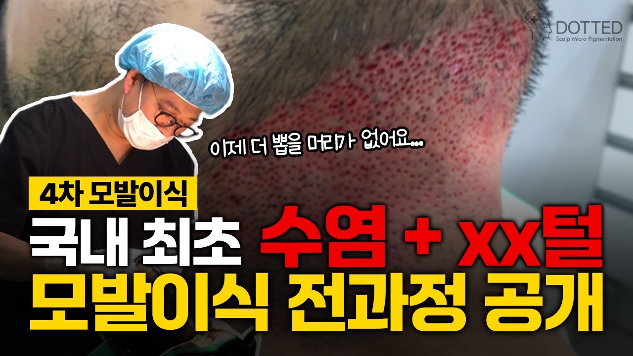 4차 모발이식｜수염도 모자라서… xx털까지 심었습니다 (국내 최초)