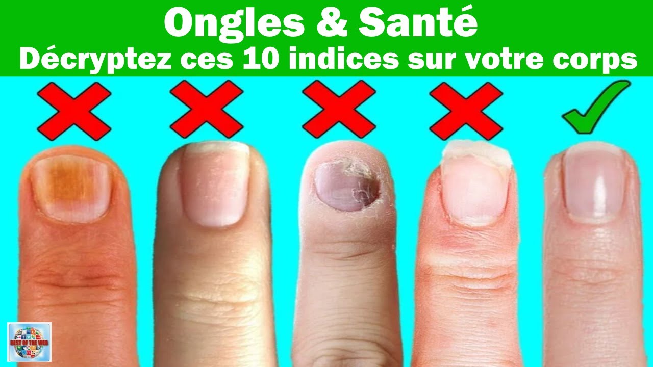 Ongles et sant&eacute; : D&eacute;cryptez ces 10 indices sur votre corps