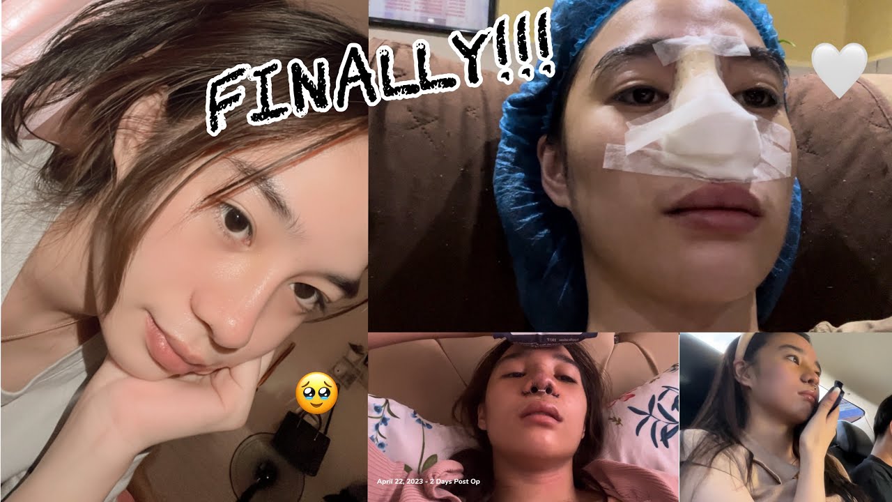 MY RHINOPLASTY JOURNEY pt. 1 | Mary Lite Lamayo