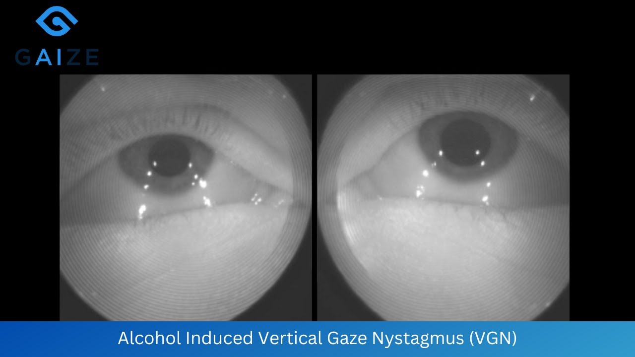 Alcohol Induced Vertical Gaze Nystagmus