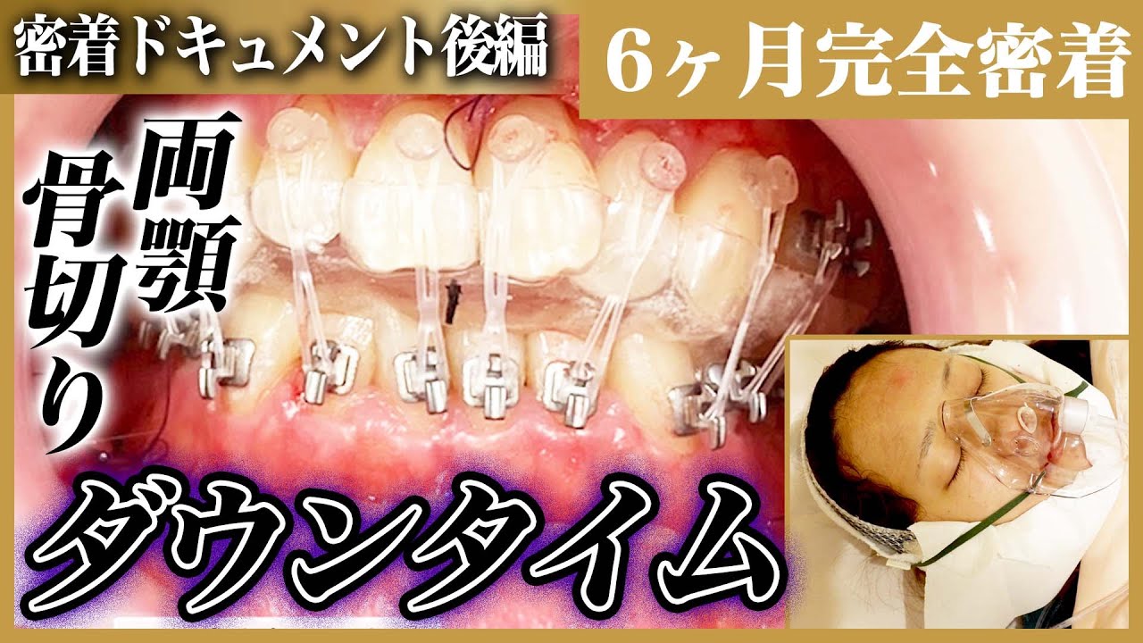 【骨切り密着#2】顎の長さ、輪郭を改善する骨切り手術のダウンタイムに完全密着！食事や痛み・腫れは？半年後でどこまで完成する？【リッツ美容外科廣比利次】