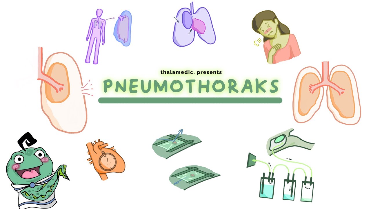 PNEUMOTHORAKS | Yuk bahas tuntas mengenai pneumothoraks⁉️