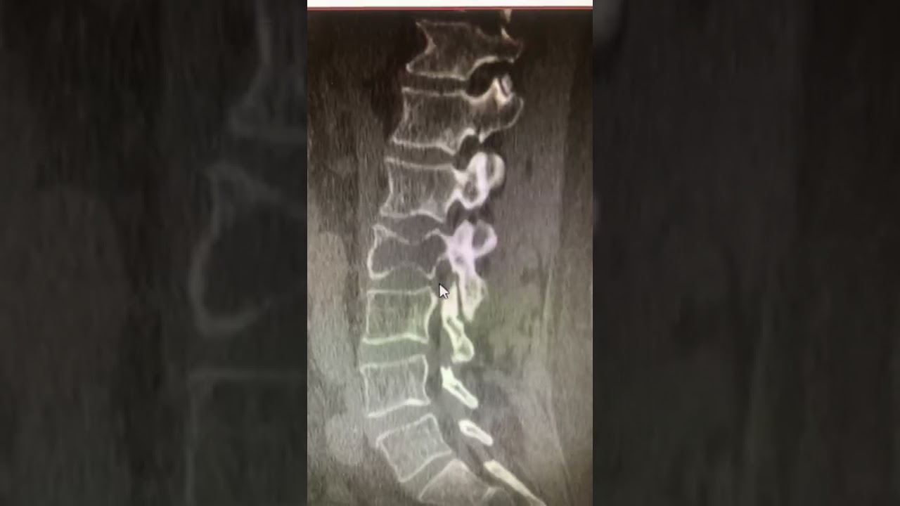 TOMOGRAFIA - MET&Aacute;STASE NA COLUNA VERTEBRAL