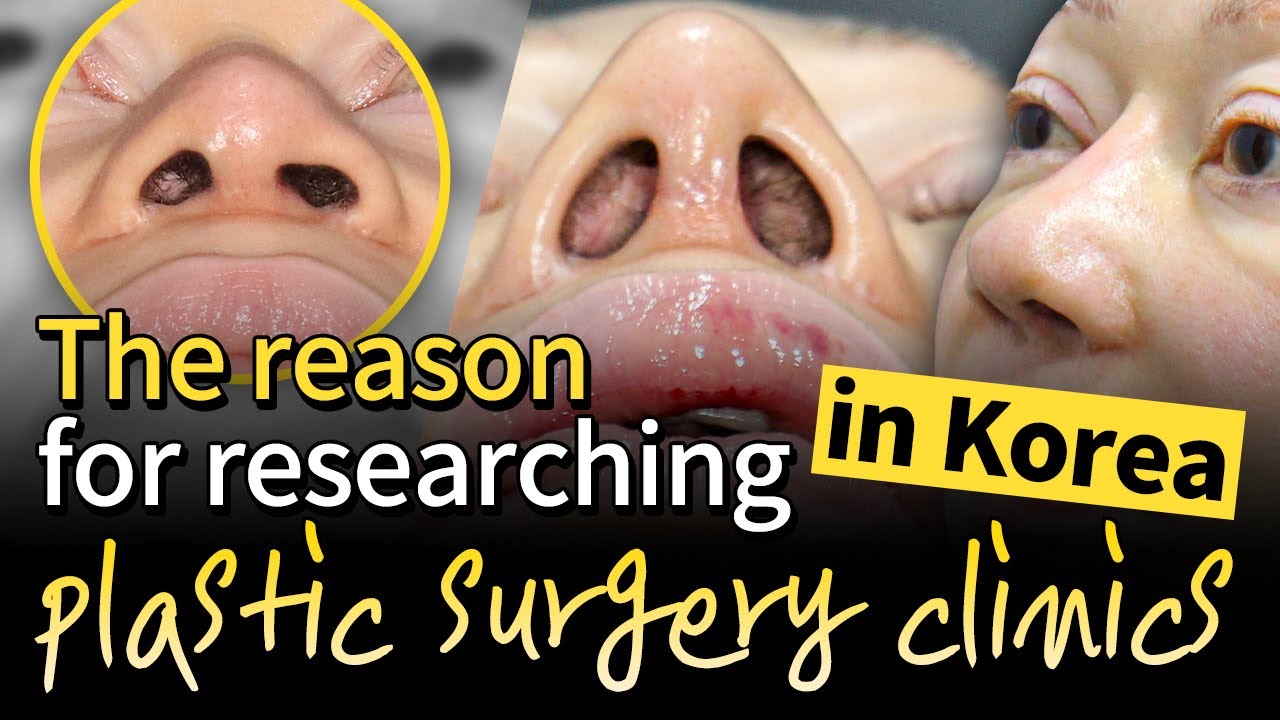 ✨💜REAL REVIEW: Revision rhinoplasty in Korea with Dr.Kim Han-Jo after a failed surgery in the U.S.✨💜