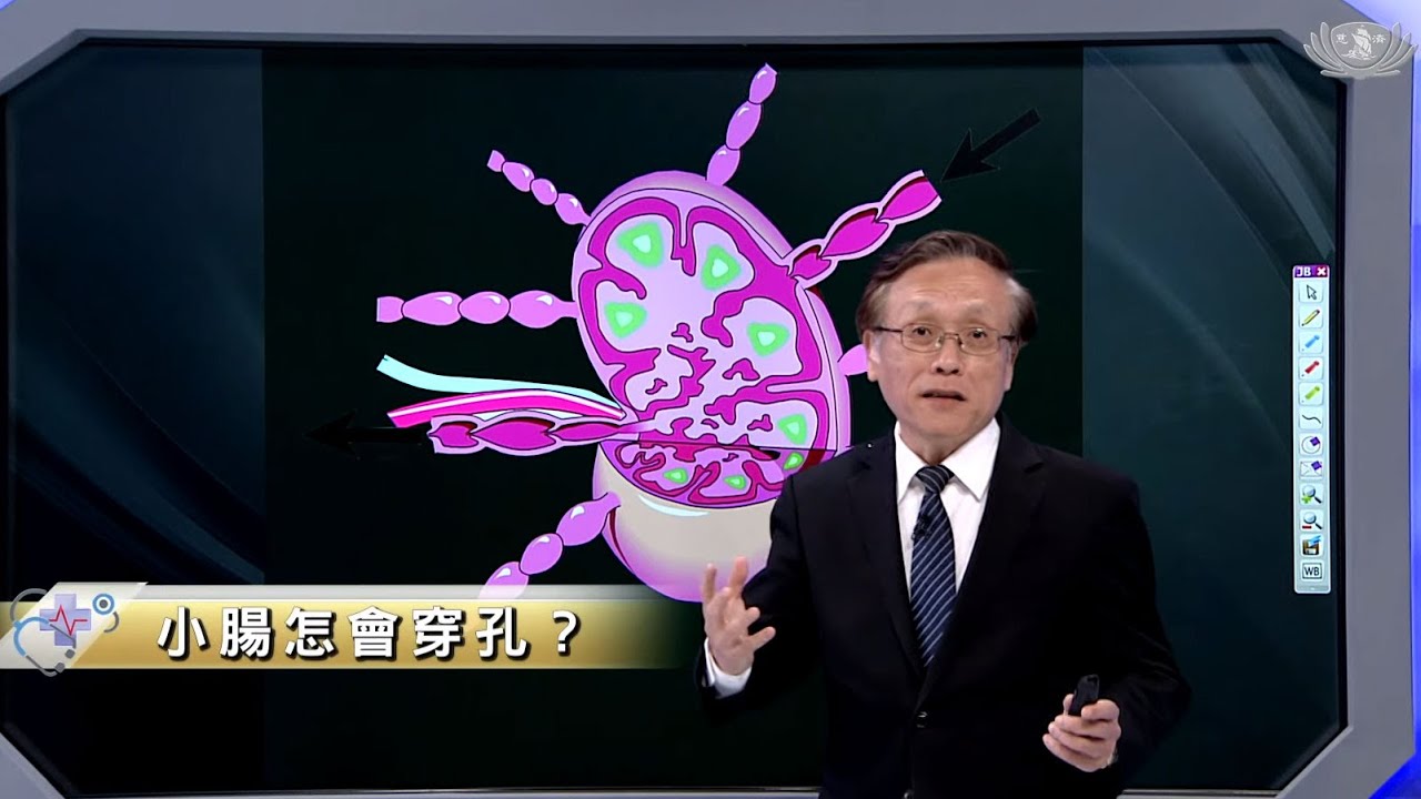【大愛醫生館】小腸怎會穿孔？ 20231010