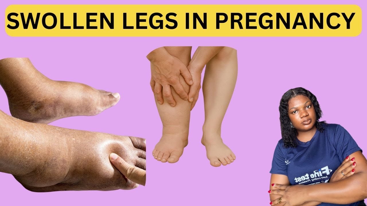 What no on tells you about swollen legs /edema/causes &home remedies