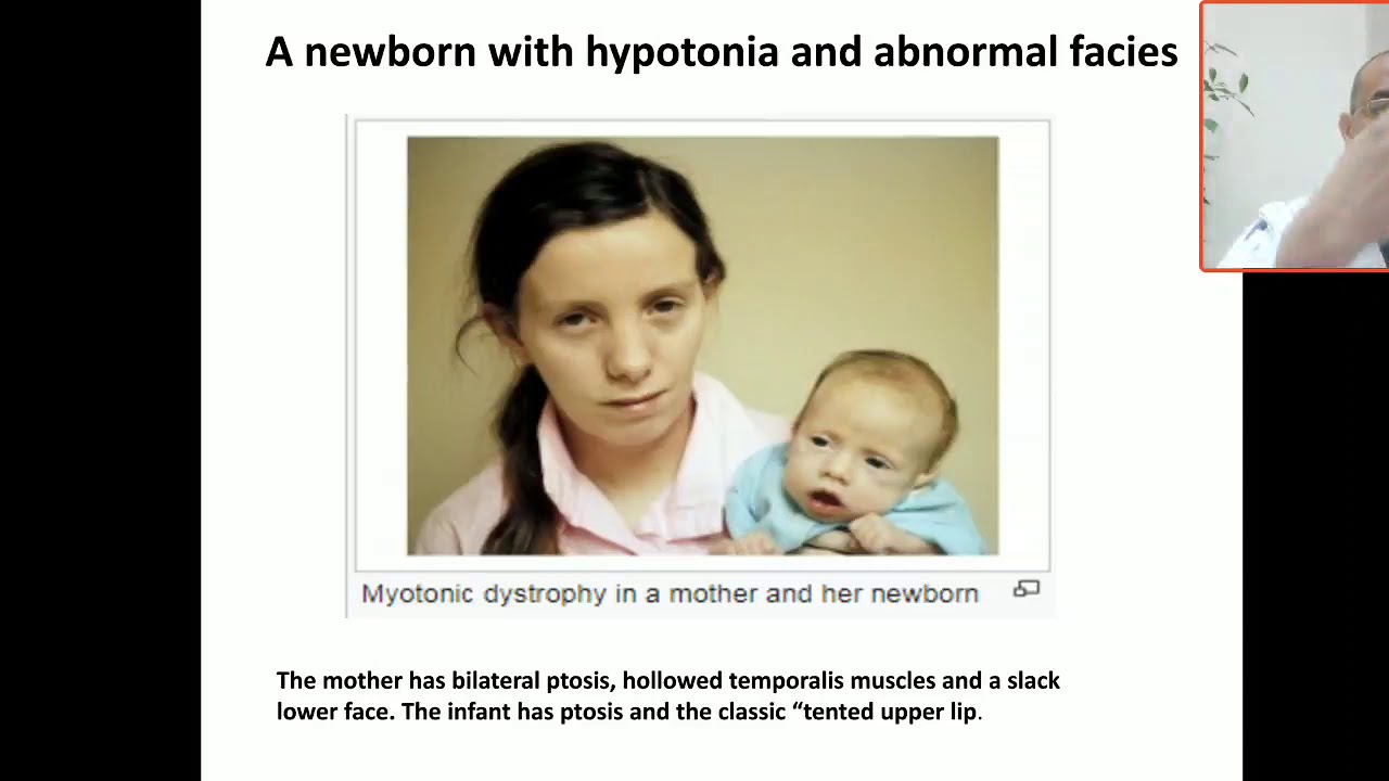 Case 114  newborn with hypotonia and abnormal face, congenital myotonia dystrophica CMD, myopathic f