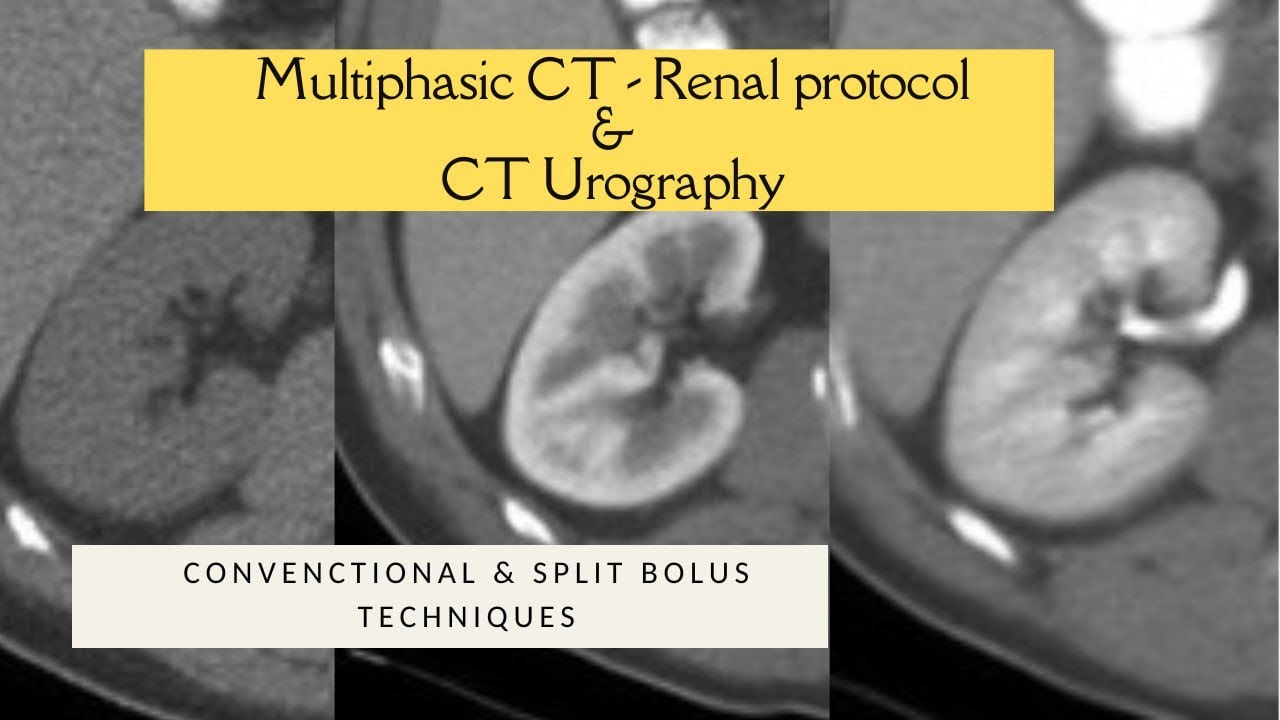 MULTIPHASIC RENAL CECT PROTOCOL + SPLIT BOLUS TECHNIQUE. CT UROGRAPHY. Triple bolus technique