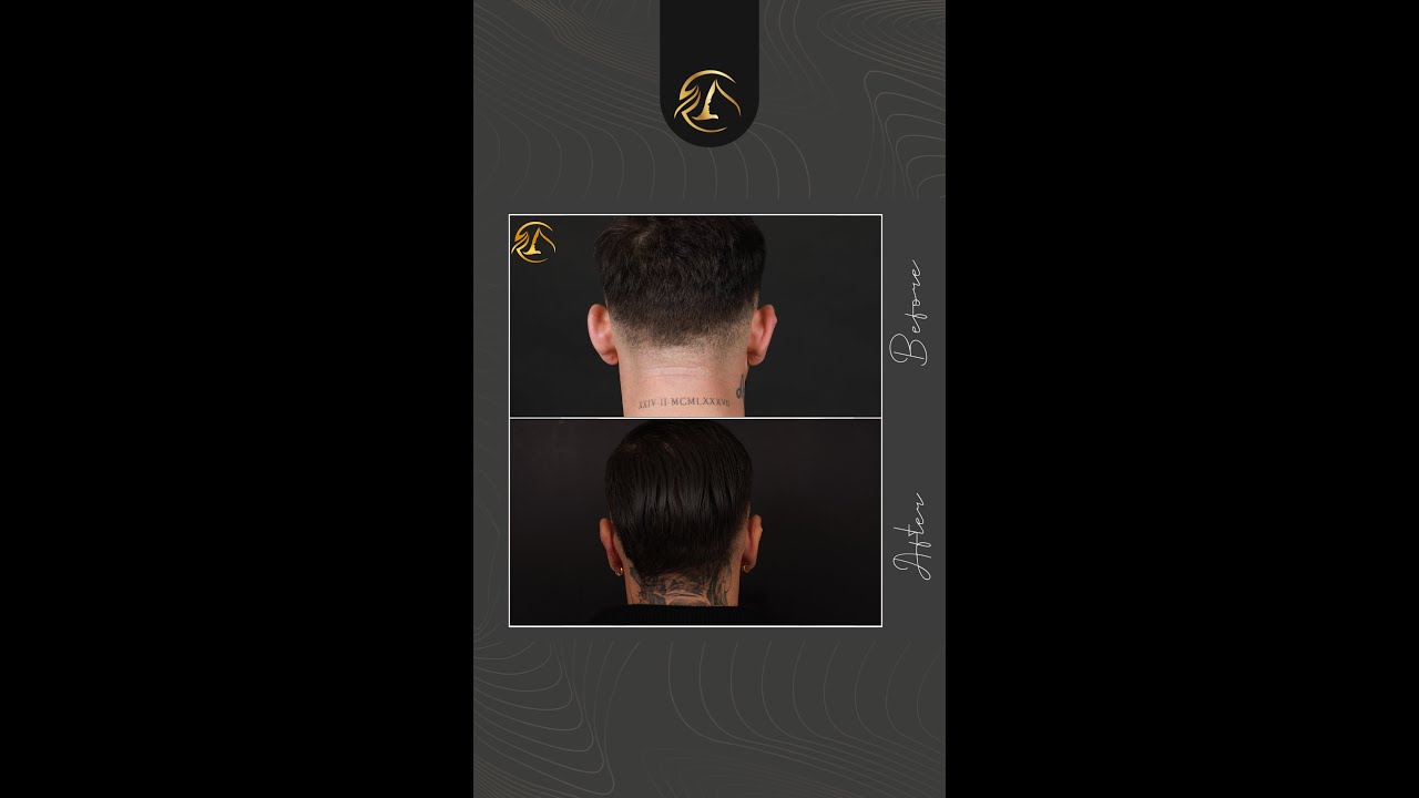 Prominent ear correction before and after – 3 years post-op