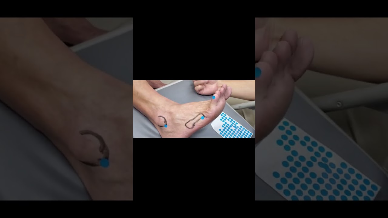 #acupuncture #崑崙 申脈 束骨 至陰
