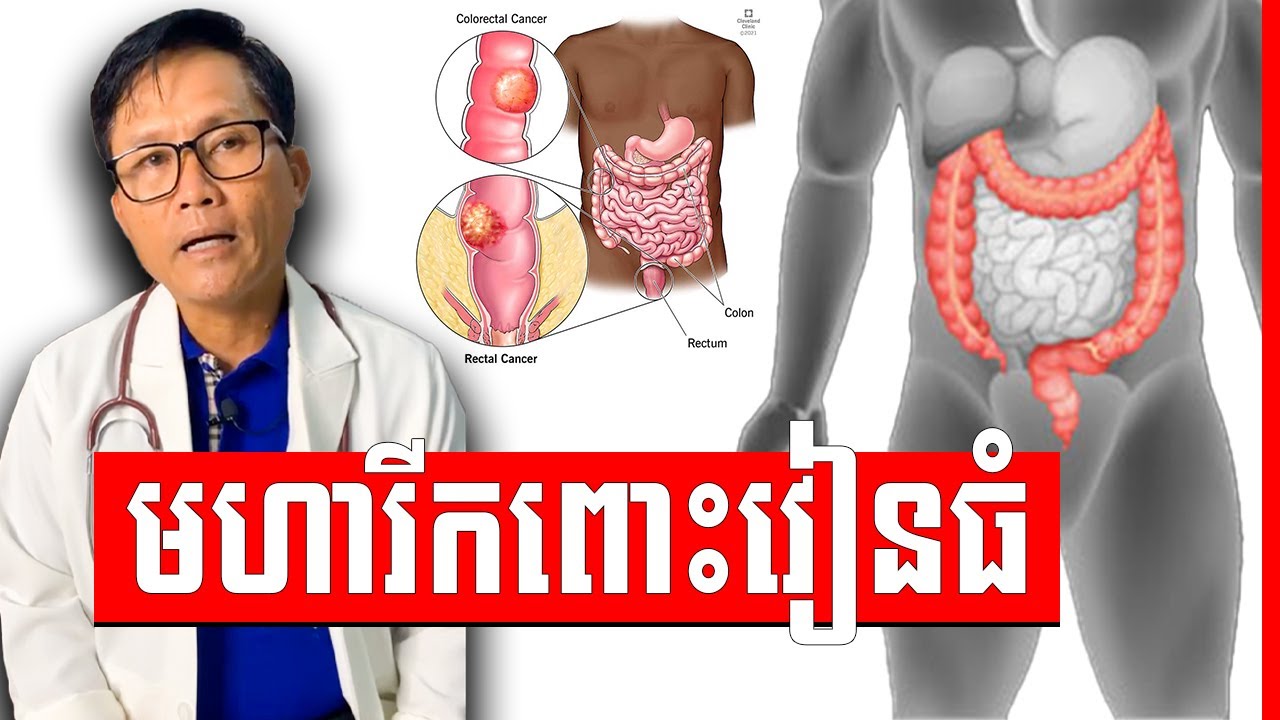 ជម្ងឺ មហារីកពោះរៀនធំ វេជ្ជ. ហង្ស ដារ៉ា , Colon Cancer
