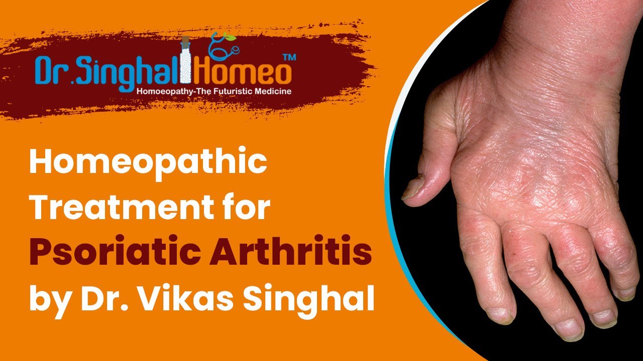 Homeopathic Treatment for Psoriatic Arthritis by Dr. Vikas Singhal