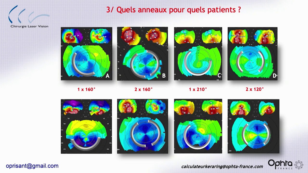 Les anneaux intra-cornéens Keraring : mise à jour et innovation avec le Dr Olivier Prisant