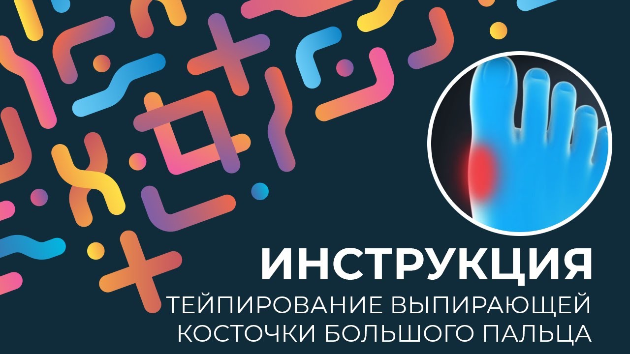 Kinexib - тейпирование выпирающей косточки большого пальца