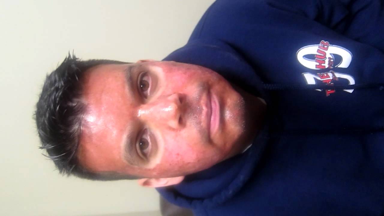 Deep Laser Peel-Follow Up Pictures-Los Angeles-Pasadena-Irvine-Fullerton