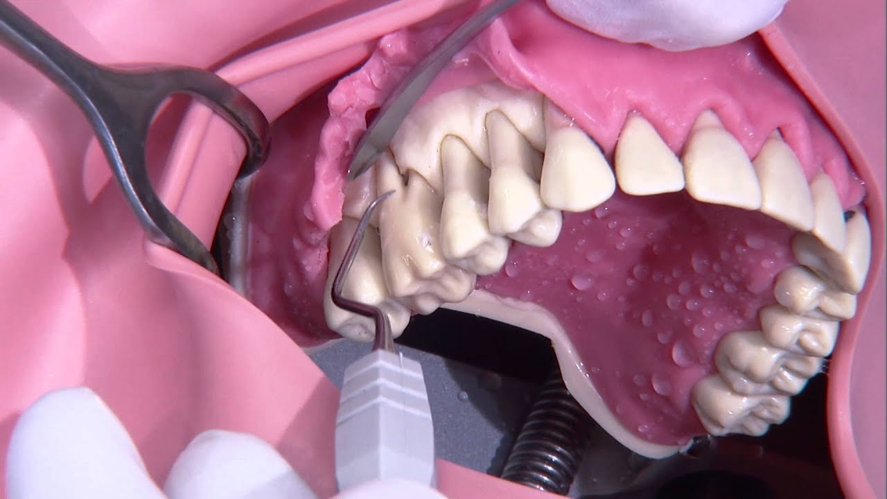 Cirug&iacute;a periodontal (Colgajo de Widman)