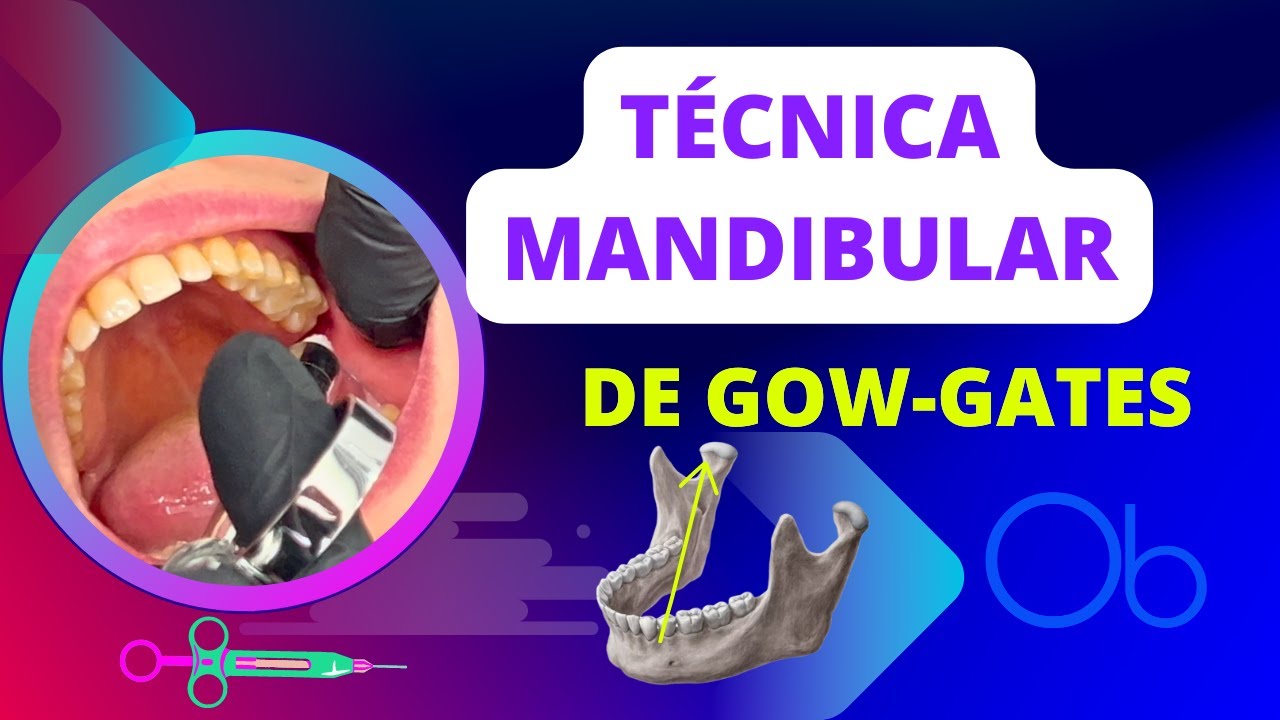 Técnica Mandibular de Gow-Gates