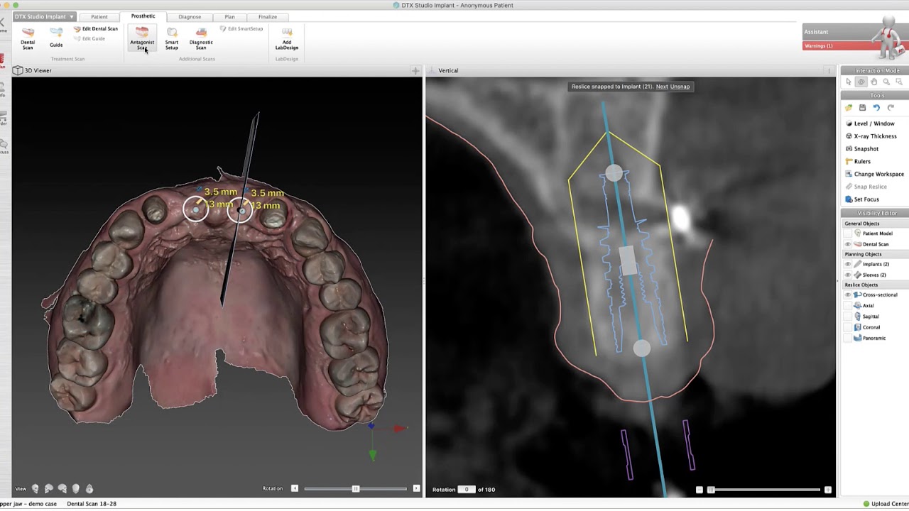Import IOS Stl scan and create virtual tooth setup in DTX Implant Studio