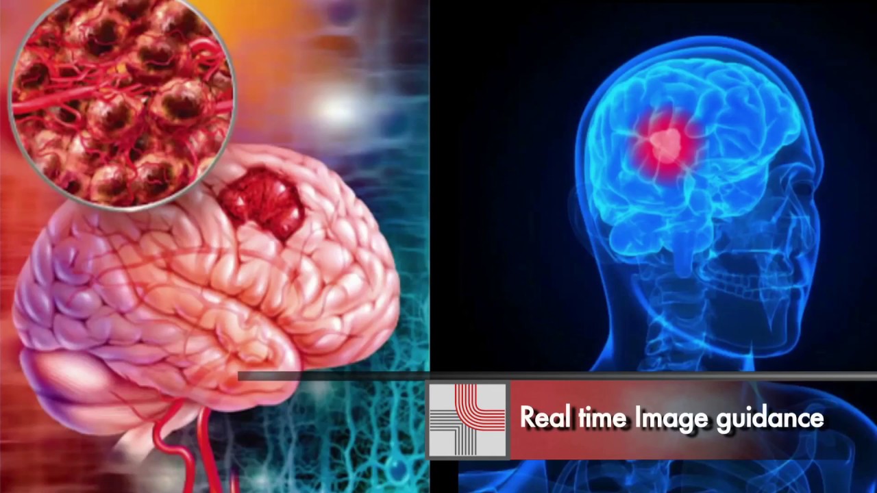 Cyberknife Robotic Radio Surgery System - Tumor Treatment in India | Medanta