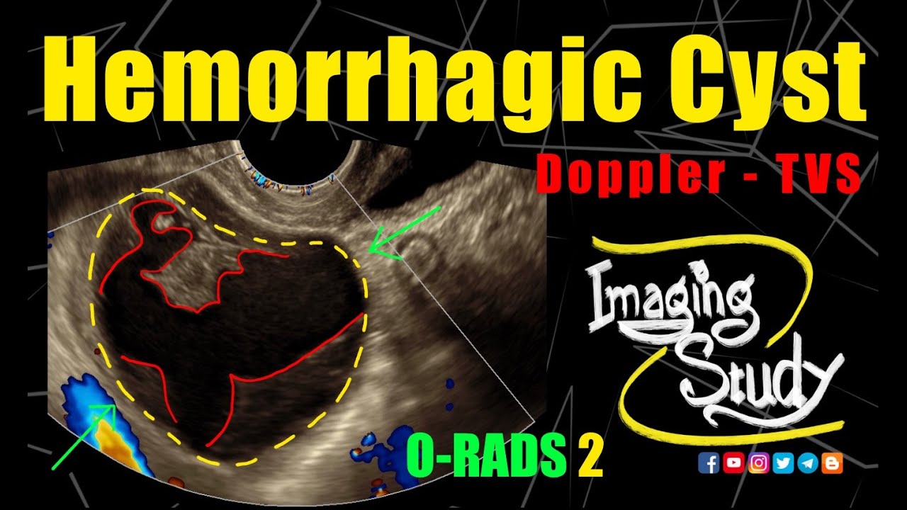 Hemorrhagic Ovarian Cyst || O-RADS US 2 || TVS || Doppler || Ultrasound || Case 269