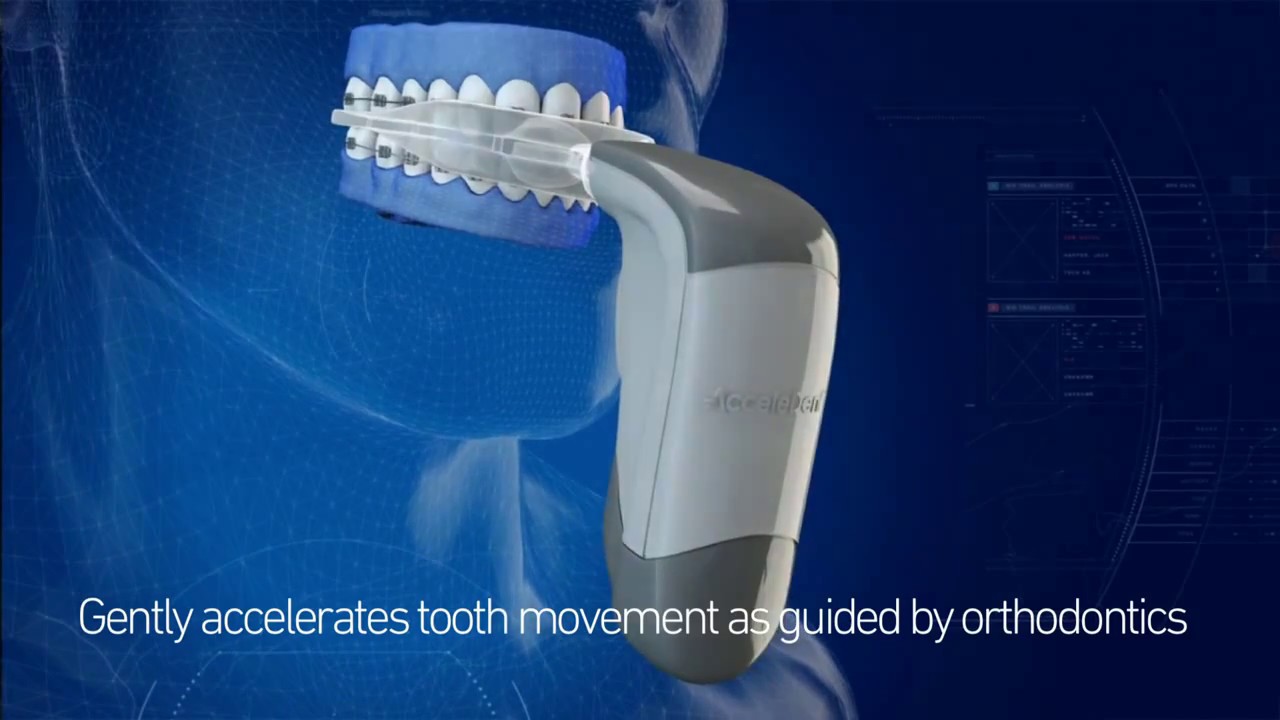 Introducing AcceleDent&reg; at NYC Smile Design