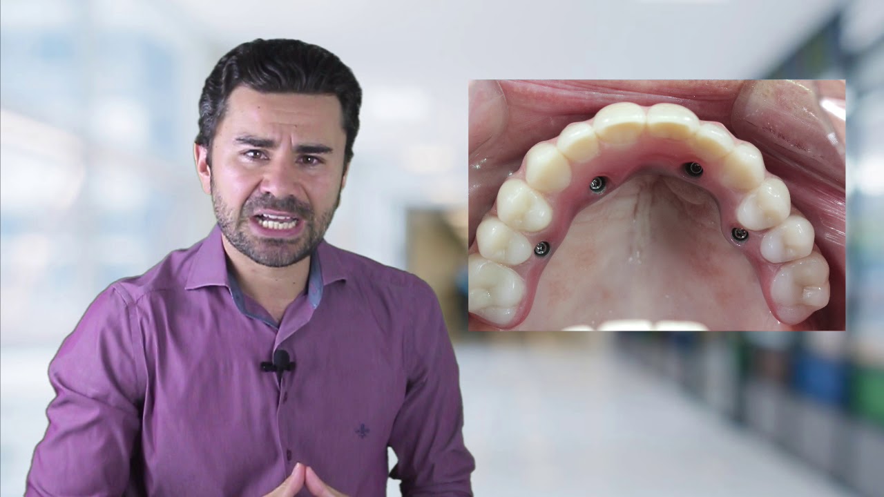 Tenha Dentes Fixos e se Arrependa! quando o sonho do implante dent&aacute;rio vira pesadelo Vers&atilde;o Editado