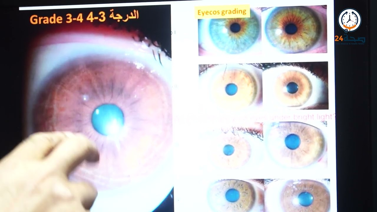 تقنية تلوين العيون بالليزر مع أ  د أسامة النحراوي
