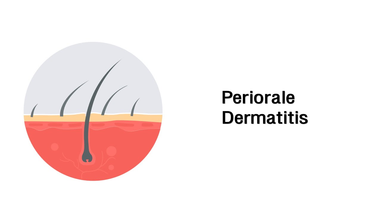 Periorale Dermatitis - Erkrankungen der Haut