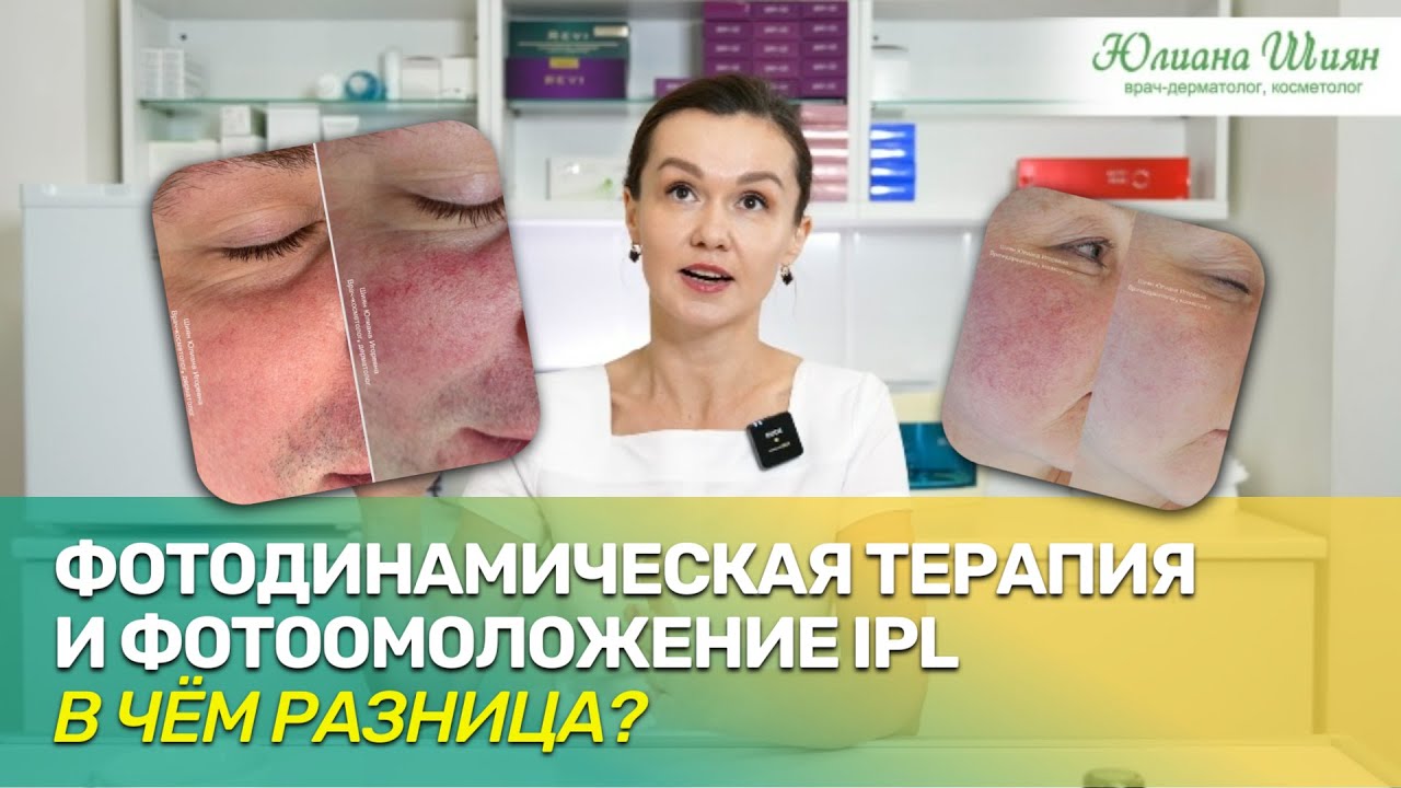 Фотодинамическая терапия и фотоомоложение IPL: в чём отличие? (розацеа, купероз, красное лицо)