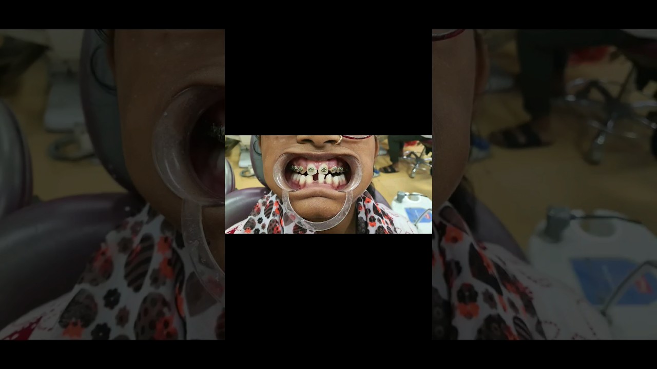 Happy patient 😁😁🤩 #braces#dentist#doctor#bds#shorts #trending#viral