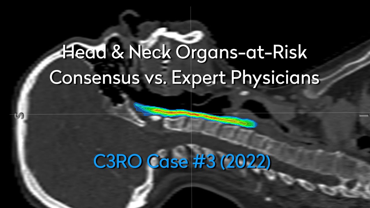 Head & Neck Organs-at-Risk: Consensus vs. Expert Physicians