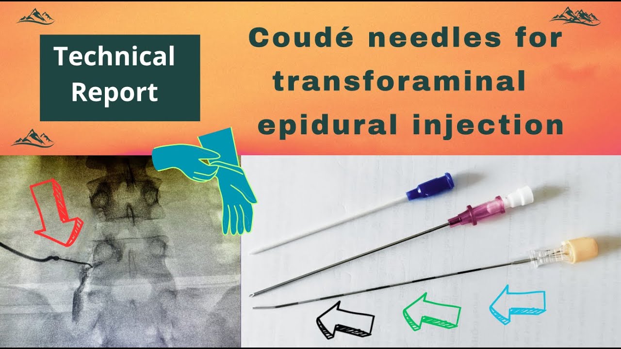 Transforaminal epidural steroid injection using Coudé needle: A technical report. Video # 153