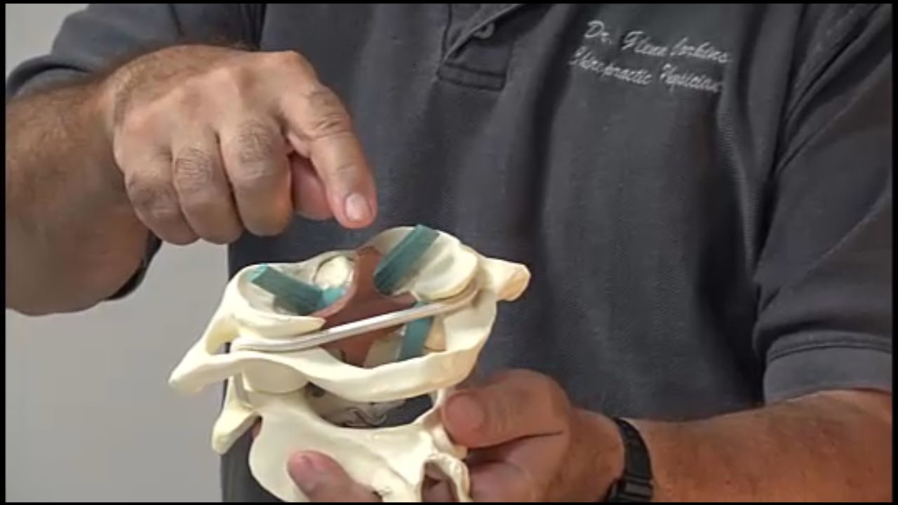 Transverse ligament damage  (Severely broken neck)