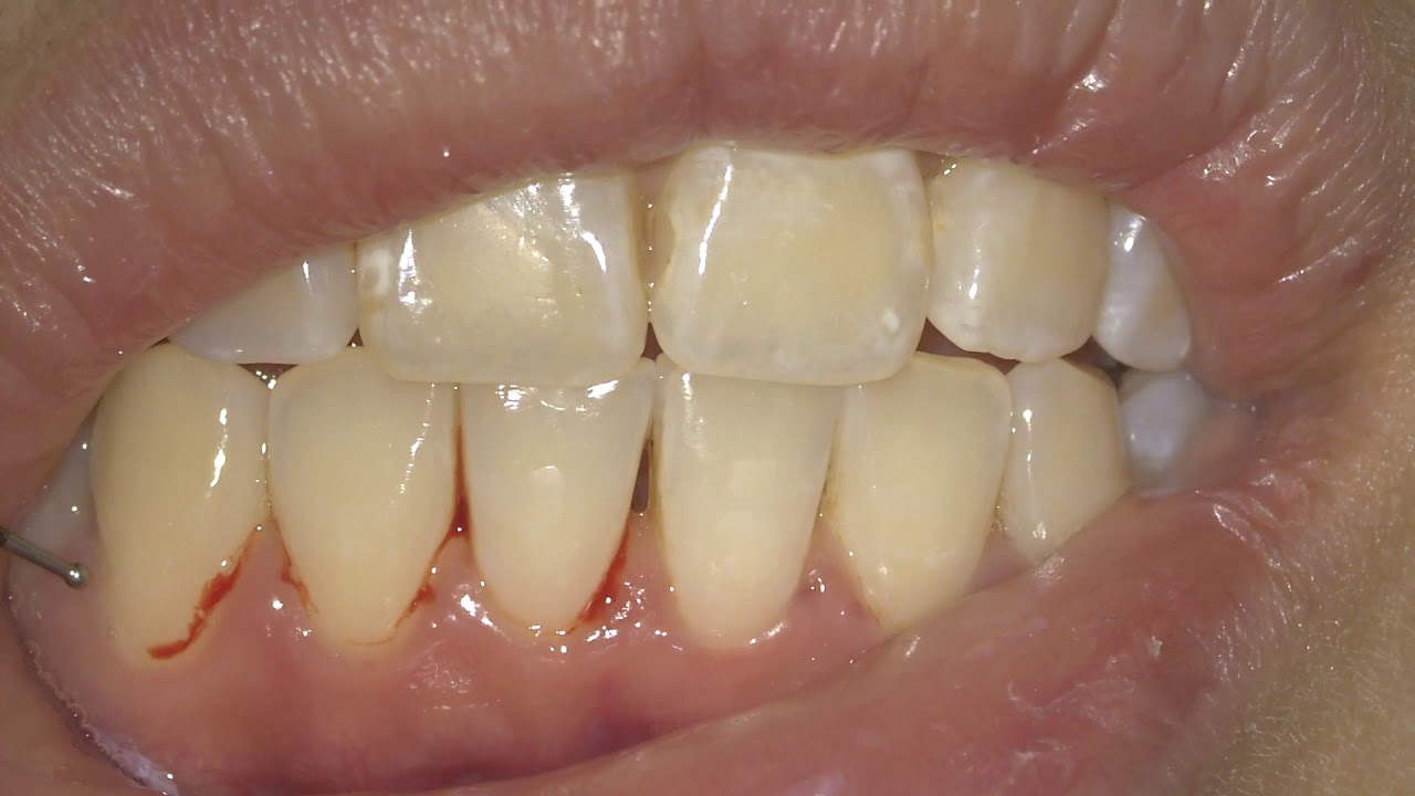 [Periodontal Examination Series] 5. BOP and Full Mouth Bleeding Score