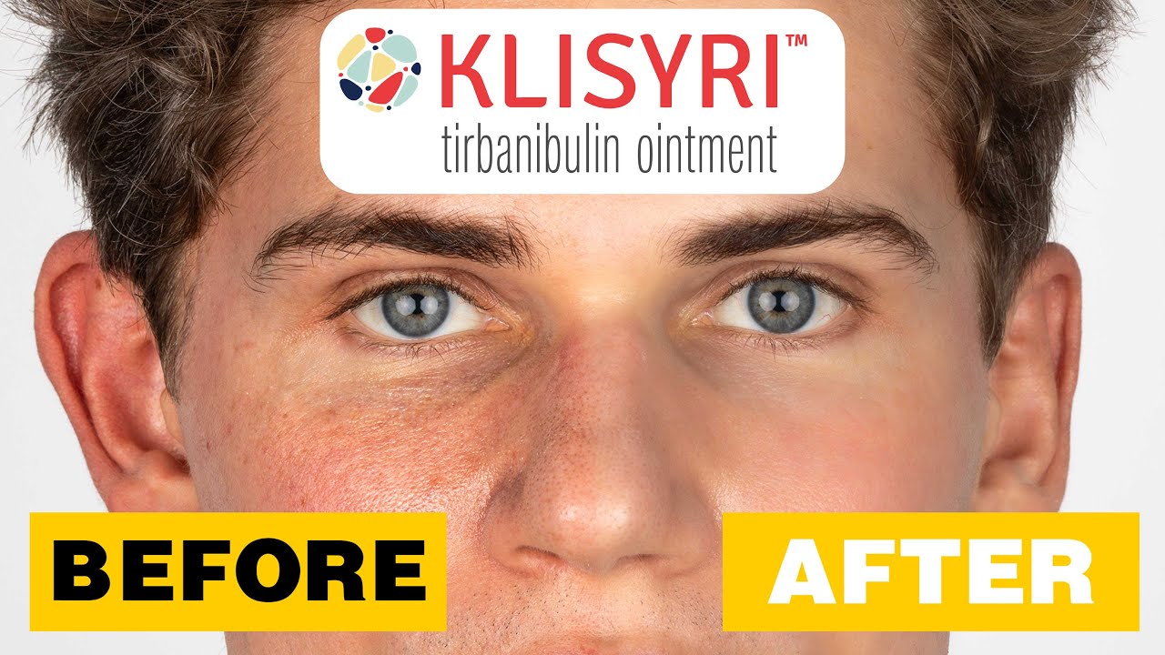 Klisyri: A topical chemotherapy drug that may reverse aging and improve hyperpigmentation