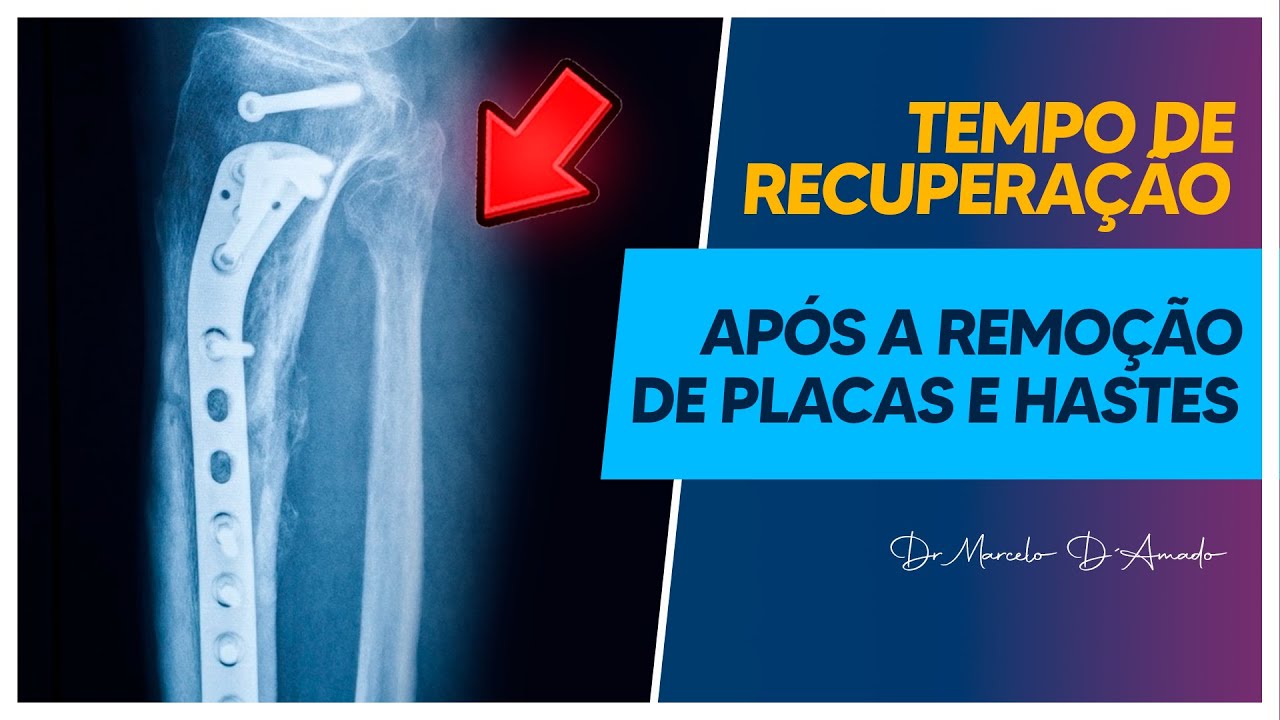 RECUPERAÇÃO APÓS A REMOÇÃO DE PLACAS E HASTES: TEMPO SEM ANDAR E RISCO DE FRATURA.