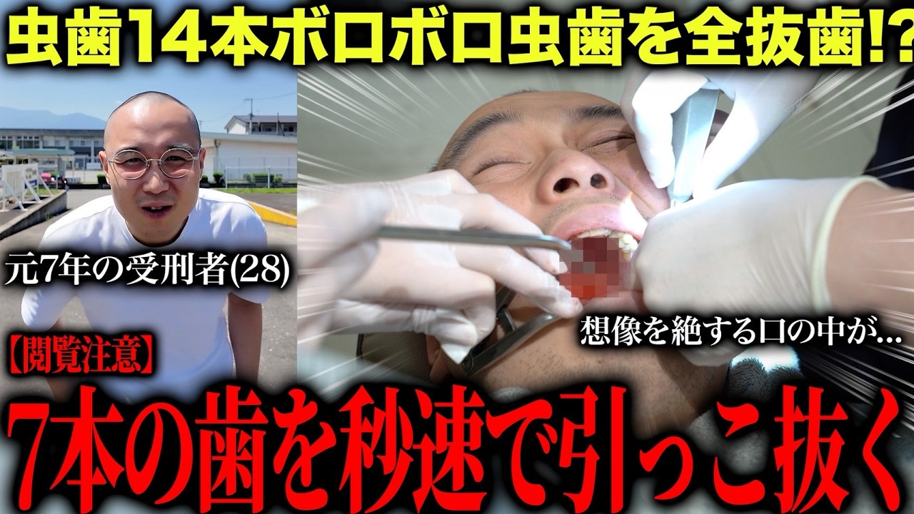 【元受刑者の虫歯治療】1日で抜歯7本   !  懲役7年でボロボロで14本の虫歯の治療を開始したら口の中が絶望的な状況でした