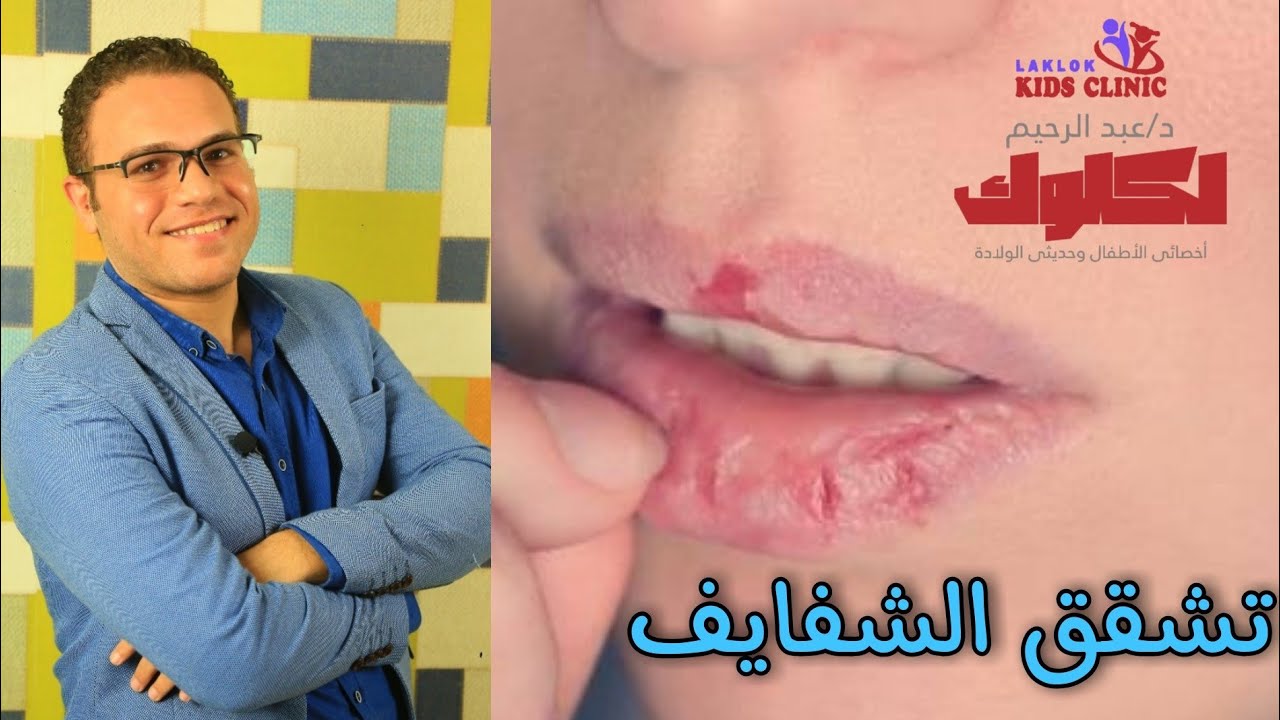 تشقق الشفايف في الأطفال
