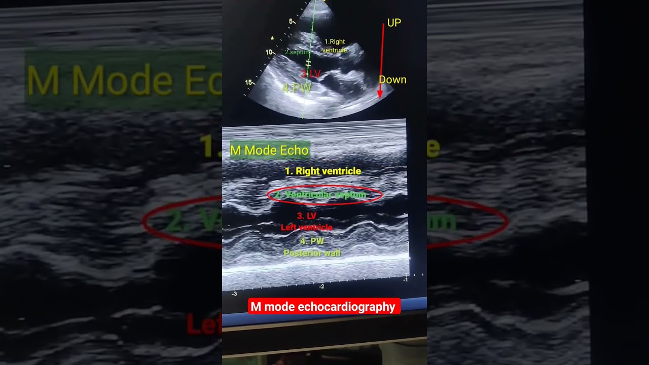 Structure in M mode echo l #echo #shorts