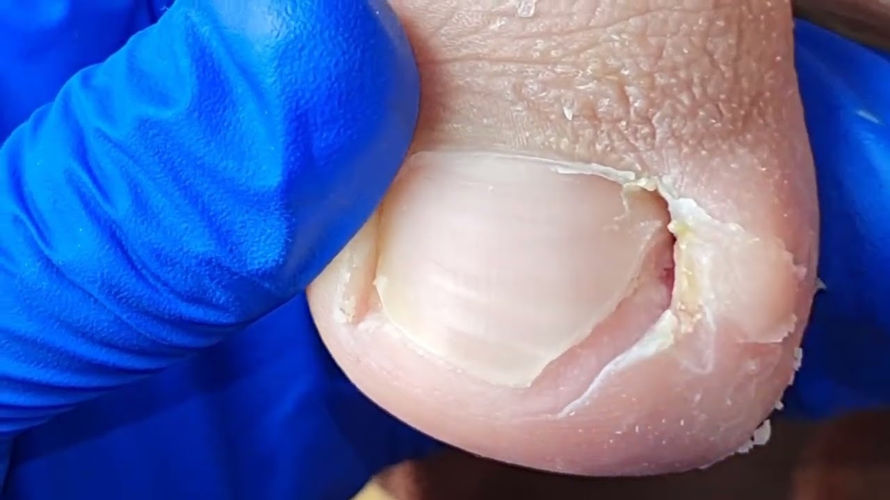 Cure! 😄Such a smooth trimming of ingrown nails【Xue Yidao】