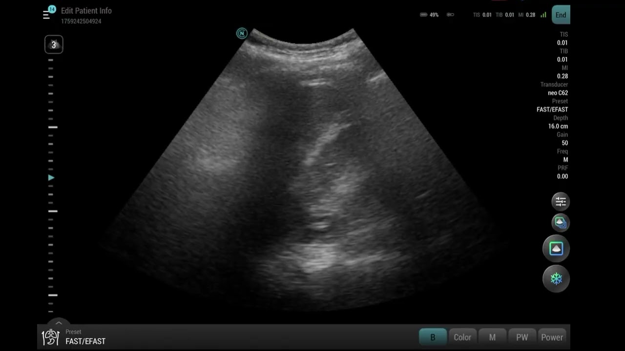Neo Ultrasound Review: A New Player in Handheld POCUS