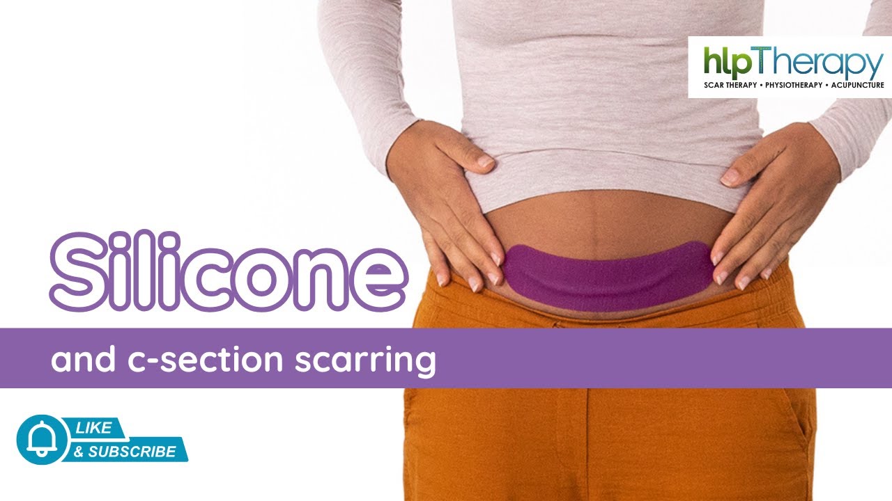 🌸 Scarban Silicone for C-Section Mums | With Hannah from HLP Therapy & BAP Medical