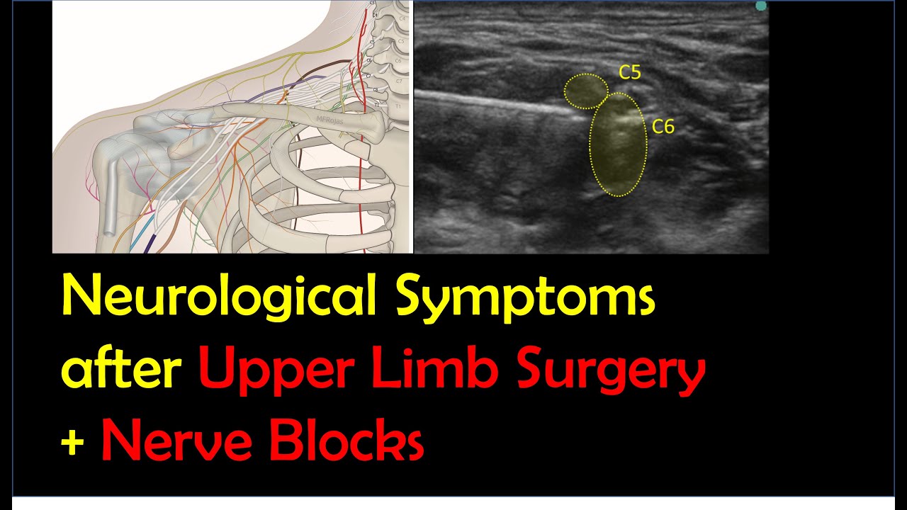 Postoperative Neurological Symptoms After Upper Limb Surgery & Nerve Blocks
