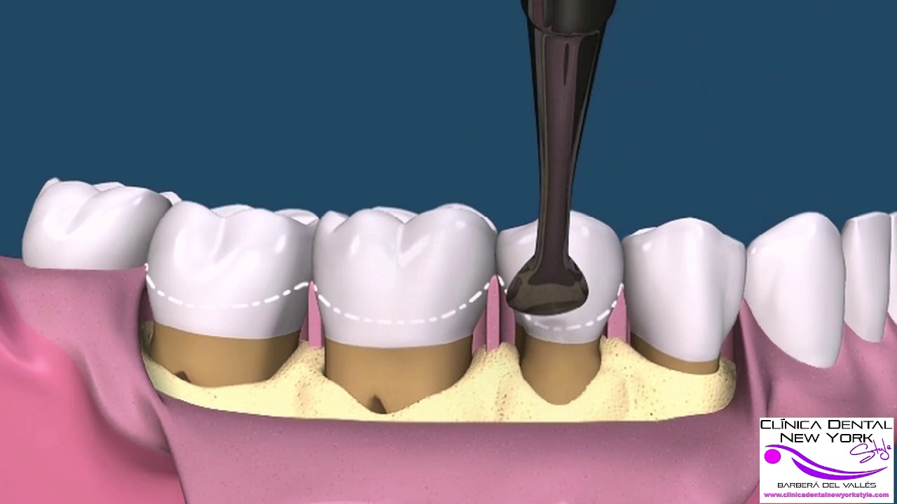 Bolsas periodontales..Reducción..