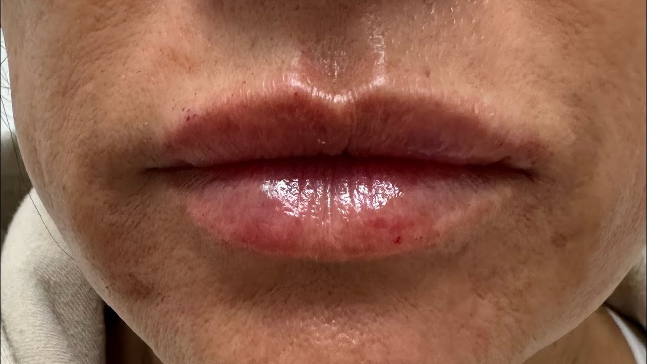 How to do lip filler correctly?